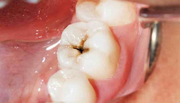 traitement curatif et préventif caries dentaires